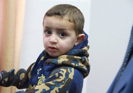 احتمالية نجاح ضئيلة لعلاج الطفل صاحب الوحمة