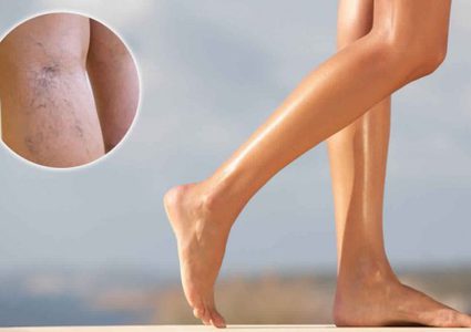 قلة النشاط والوزن الزائد ستصيبك بالأوردة العنكبوتية