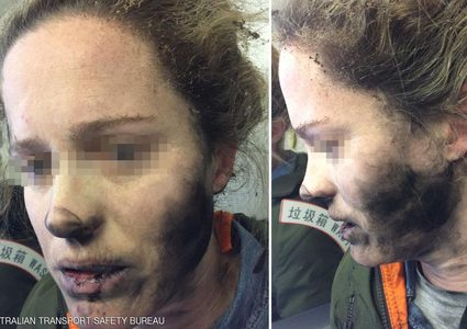 احتراق وجه إمرأة استرالية بسبب السماعات