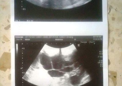 الطفلة ميرا ..  " تكيس الكلى" يخنق أنفاسها