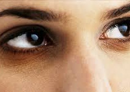 أسباب الهالات السوداء وطرق علاجها