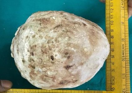 استخراج حجر وزنه 1.36 كلغ من جسد رجل