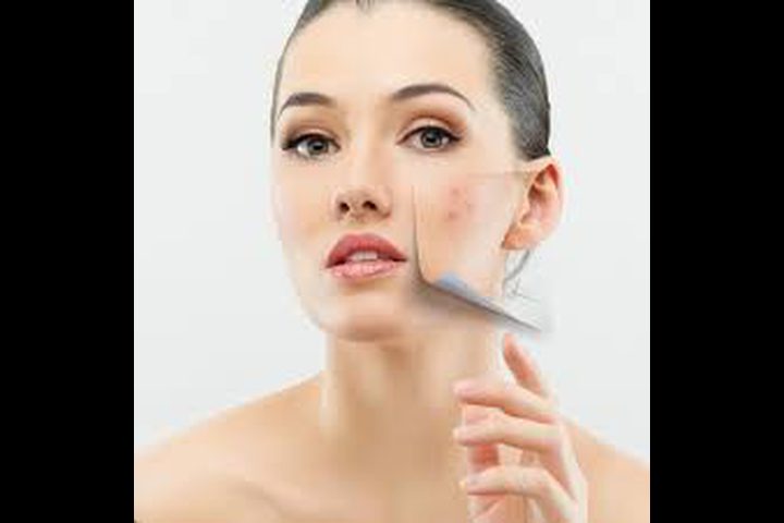 تخلصي من البثور السوداء بمكونات طبيعية