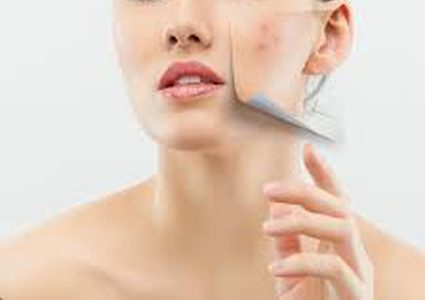 تخلصي من البثور السوداء بمكونات طبيعية