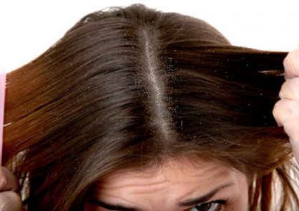 علاج إلتهابات فروة الرأس بطرق طبيعية