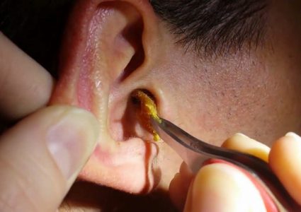 شمع الأذن مم يتكون، وما فائدته؟