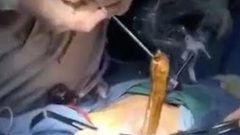استخراج ثعبان من معدة رجل صيني