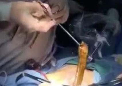 استخراج ثعبان من معدة رجل صيني