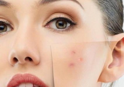 خلطات لعلاج بقع الوجه وإزالتها