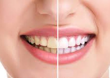 ما هي حقيقة تبيض الأسنان؟