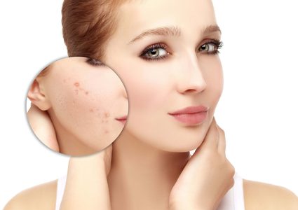 مؤكولات تجنبيها لمعالجة حب الشباب