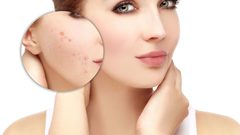 مؤكولات تجنبيها لمعالجة حب الشباب