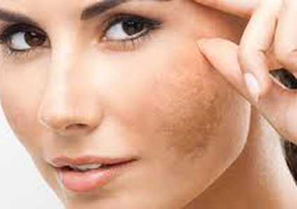 تخلصي من الكلف بالبقدونس