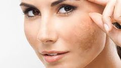 تخلصي من الكلف بالبقدونس