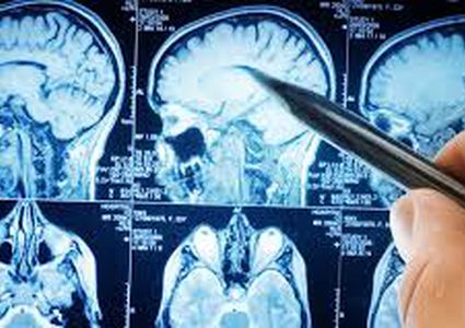 رذاذ خاص لاستئصال أورام الدماغ