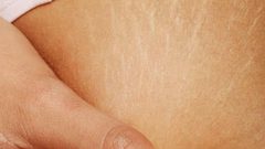 كيف تعالجين تشققات الجسم ؟