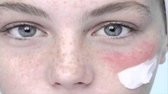 علاج حساسية الوجه واحمراره