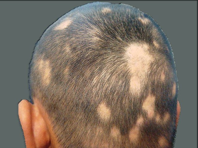 الثعلبة... ضغط نفسي أم تخفي وراءها أمراضاً أخرى؟