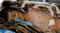 الصحة العالمية: أكثر من 600 ألف إصابة بالكوليرا باليمن