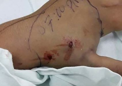 رملاوي: المصل الخاص بسم الأفاعي الموصى عليه من مصر لم يصل بعد