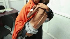 مليون اصابة بالكوليرا في اليمن مع نهاية العام