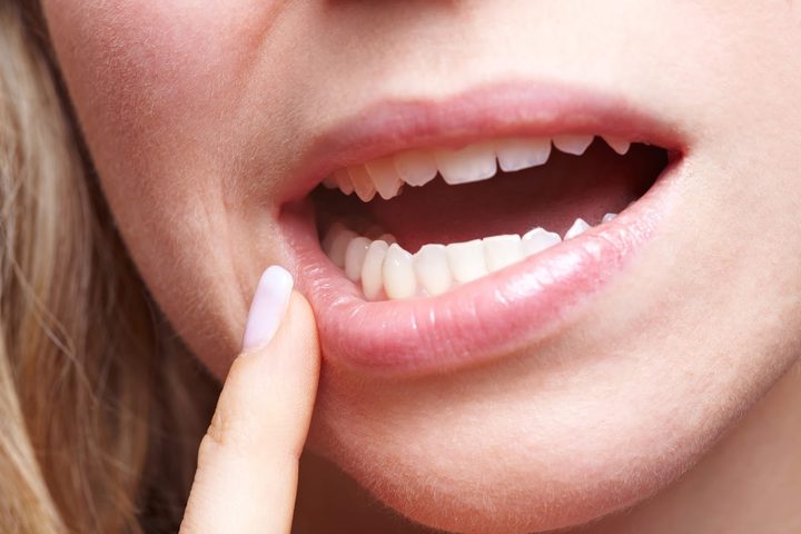 أمراض اللثة مرتبطة أكثر بمرضى السكري