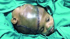 عملية نادرة لفصل توأمين ملتصقين من الرأس