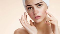 أفضل علاج لحب الشباب سريع المفعول