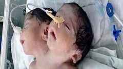 طفل برأسين في الهند
