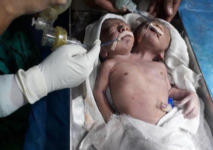 ولادة توامين ملتصقين مع راسين منفصلين وجذع واحد في الهند
