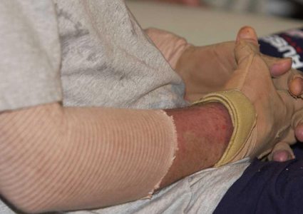 الجروح والحروق تلتئم بوتيرة أبطأ أثناء الليل