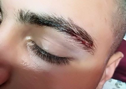 تلزيق الجروح في فلسطين...  تقنية التجميل الفوري (صور)