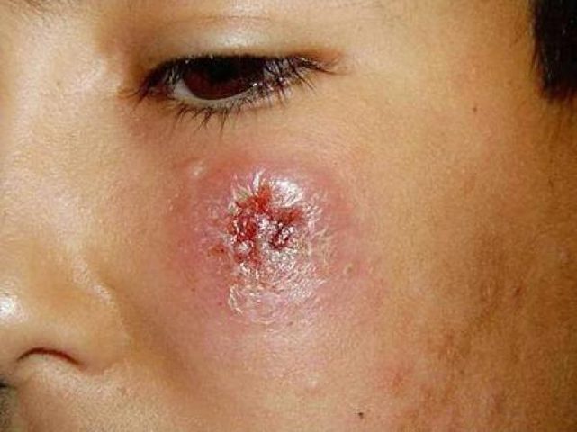 باحثان فلسطينيان يتوصلان لآلية تتبع مرض حبة أريحا "الليشمانيا"