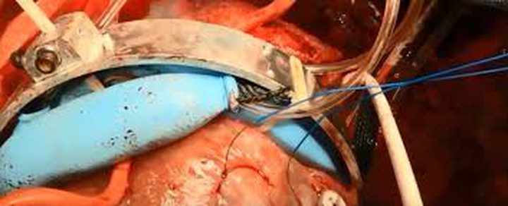 روبوت لمساعدة القلب على الاستمرار بالنبض