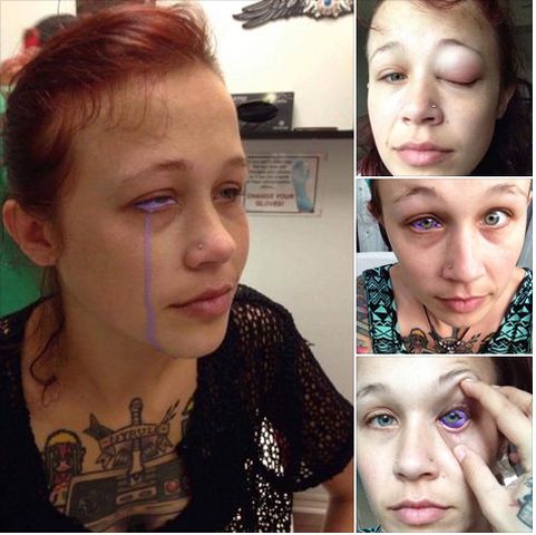 عارضة أزياء تضطر لاقتلاع عينها بعد وشمها