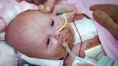 إنقاذ "إعجازي" لرضيعة قلبها خارج جسدها