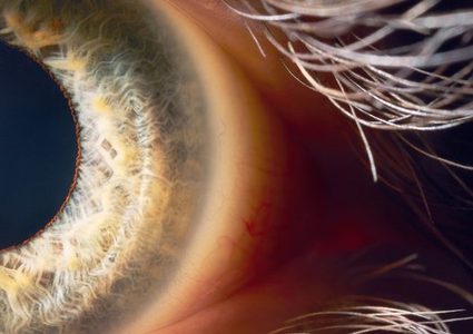 العلاج الجيني لمرض العمى الموروث