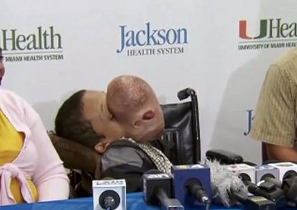 ورم يفتك بوجه مراهق ومخاوف من الجراحة بسبب خطورتها