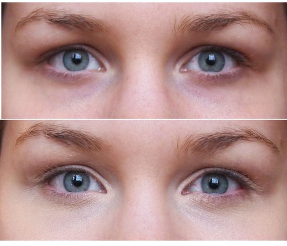 القرفة للتخلص من الجيوب المنتفخة تحت العينين