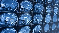 ما علاقة هيكل الدماغ بمعدل الذكاء؟