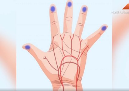 أضرار فرقعة أصابعك (فيديو)