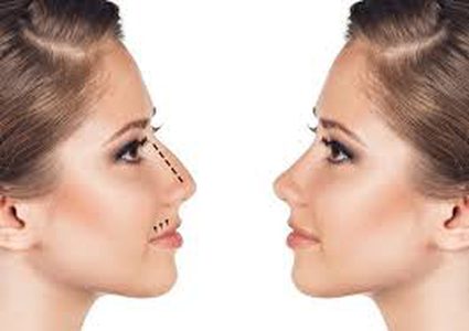 طريقة ثورية لتجميل الأنف بالخيوط دون الجراحة