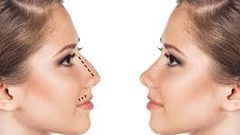 طريقة ثورية لتجميل الأنف بالخيوط دون الجراحة