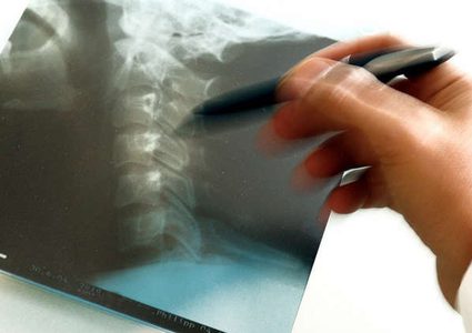 جينات الأسماك مفتاح علاج الشلل لدى البشر