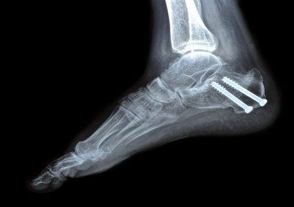 إيقاف استخدام التيتانيوم في جراحة العظام