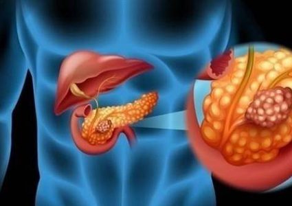 فيروس معدّل وراثياً يحارب هذا النوع من السرطان