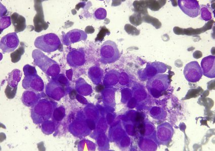 علماء يعثرون على أولى علامات ظهور السرطان!