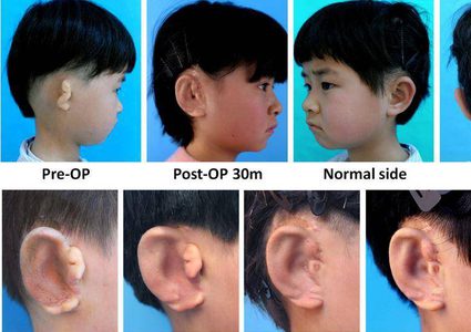 طفل يحصل على أذن جديدة من خلايا جسمه!