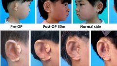 طفل يحصل على أذن جديدة من خلايا جسمه!