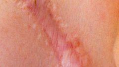 اكتشاف جديد يمكن أن يساعد في القضاء على الندوب